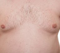CoolSculpting chest