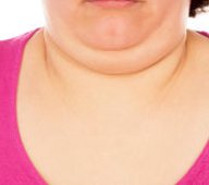 CoolSculpting female chin