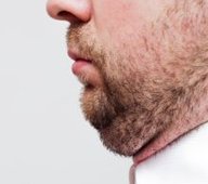 CoolSculpting male chin