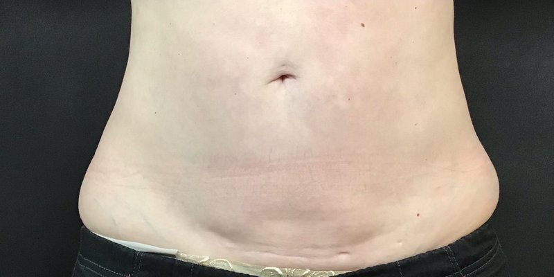 CoolSculpting abdomen after