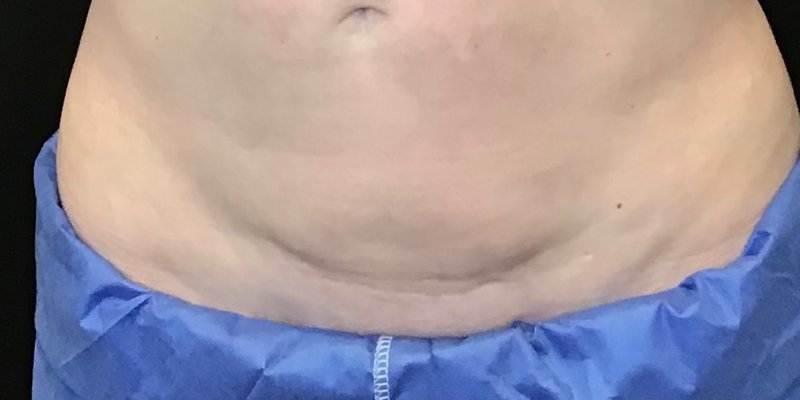 CoolSculpting abdomen before