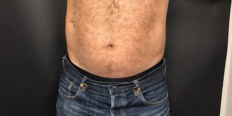 CoolSculpting male abdomen after