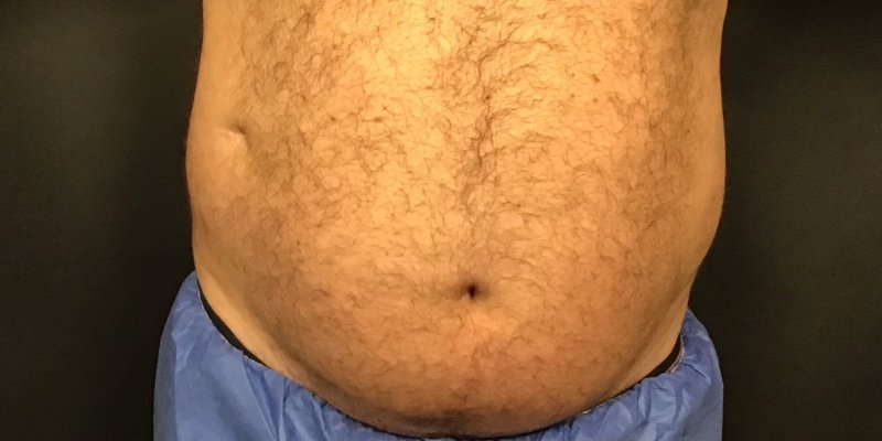 CoolSculpting male abdomen before