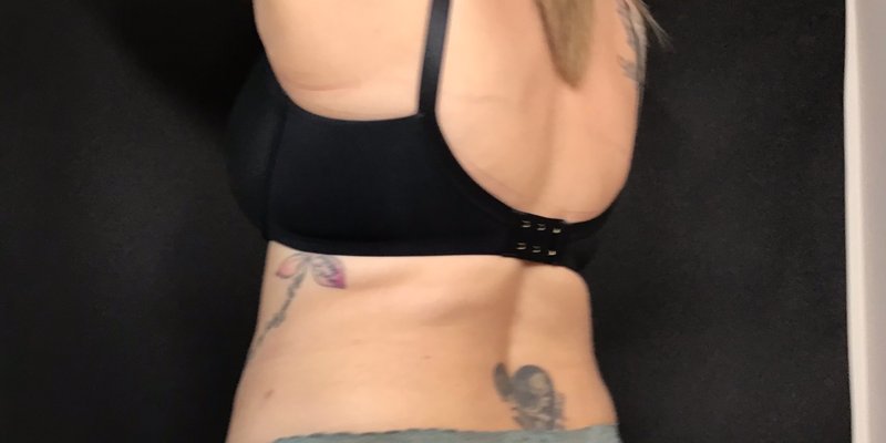 CoolSculpting flanks after